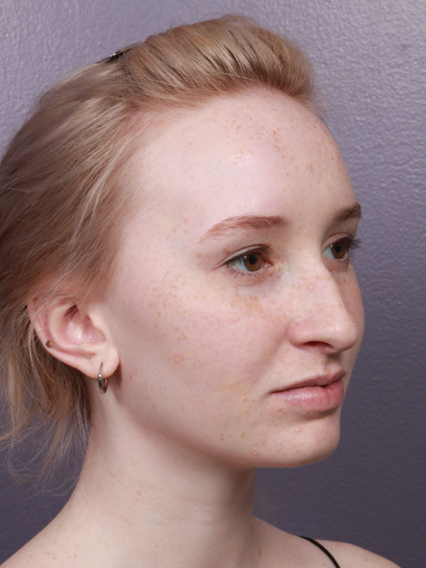 Rhinoplasty Before & After Image