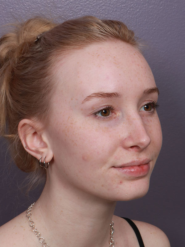 Rhinoplasty Before & After Image