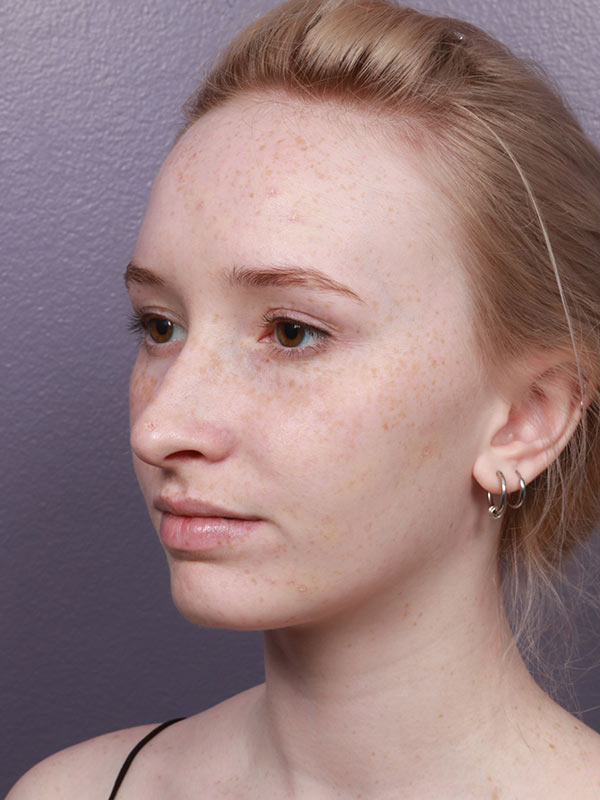 Rhinoplasty Before & After Image