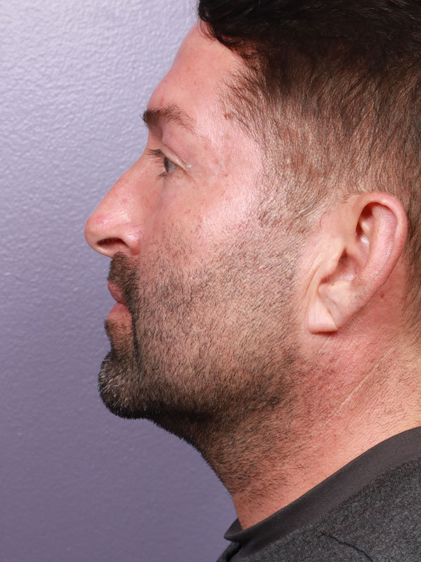 Rhinoplasty Before & After Image