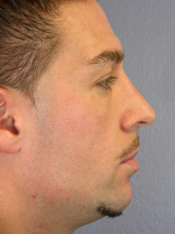 Rhinoplasty Before & After Image