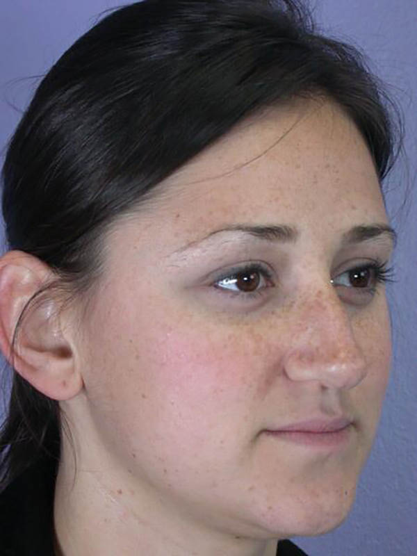 Rhinoplasty Before & After Image