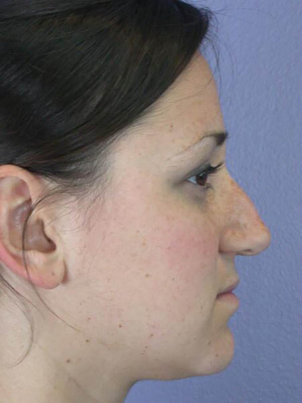 Rhinoplasty Before & After Image