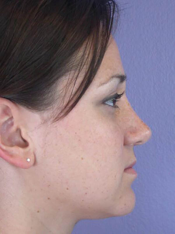 Rhinoplasty Before & After Image