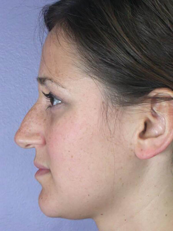 Rhinoplasty Before & After Image