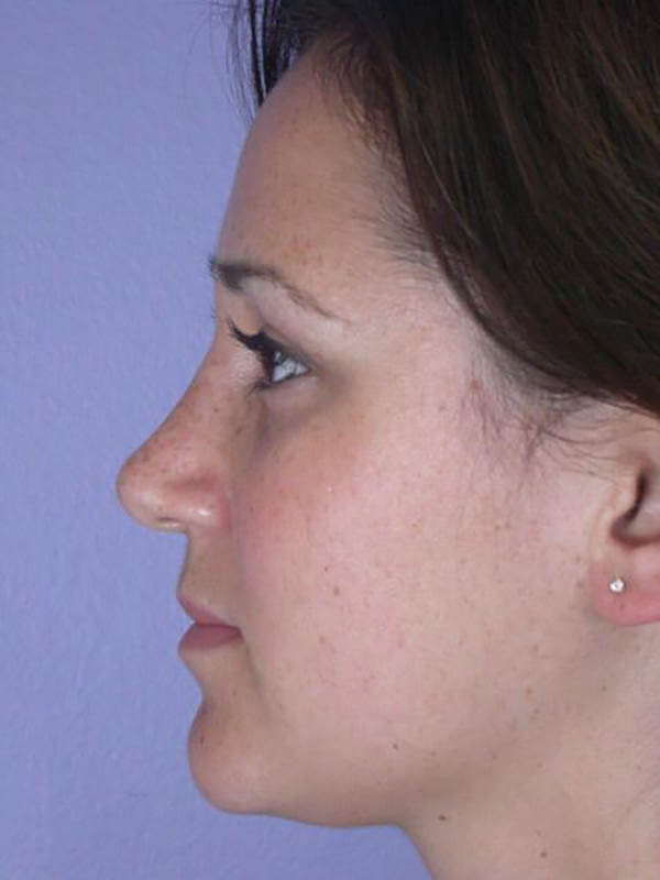 Rhinoplasty Before & After Image