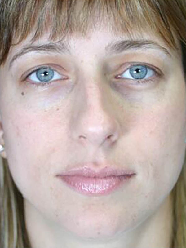 Rhinoplasty Before & After Image