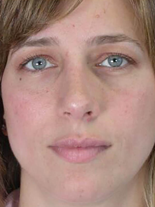 Rhinoplasty Before & After Image