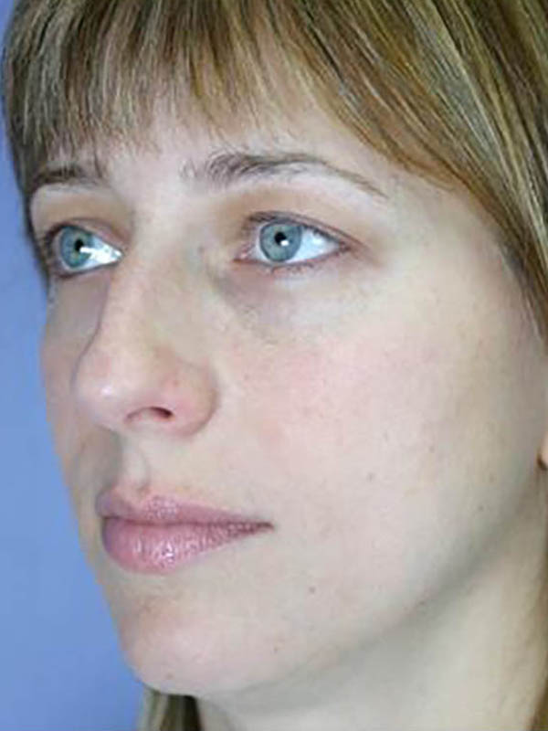 Rhinoplasty Before & After Image