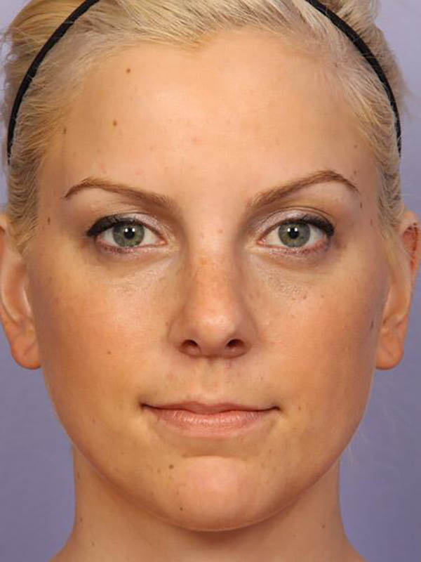 Rhinoplasty Before & After Image