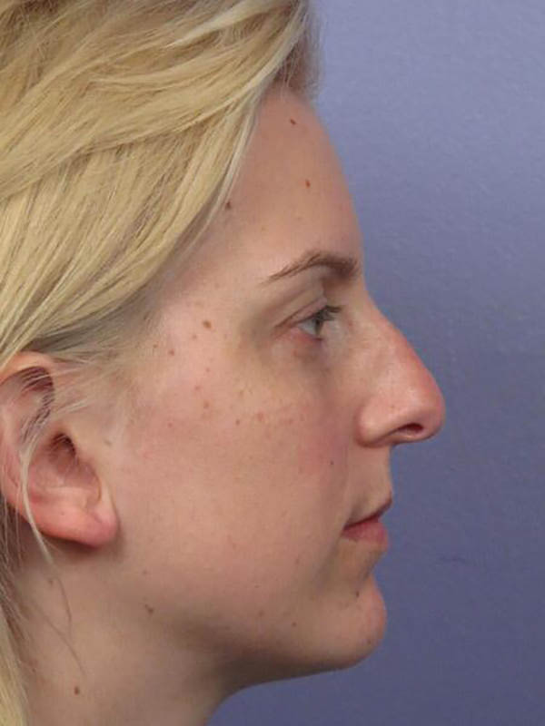 Rhinoplasty Before & After Image