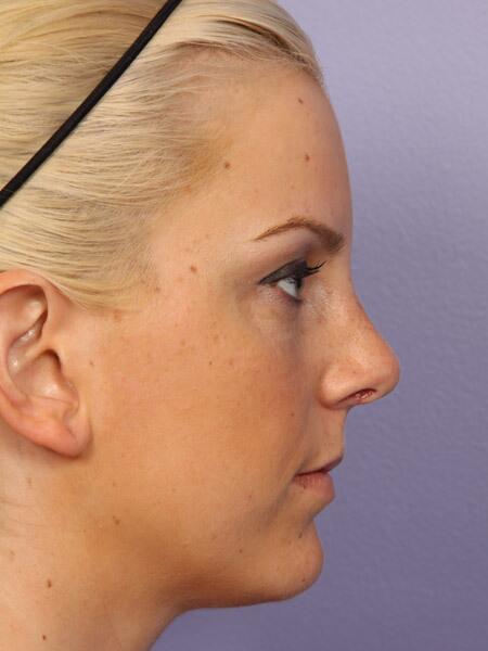 Rhinoplasty Before & After Image