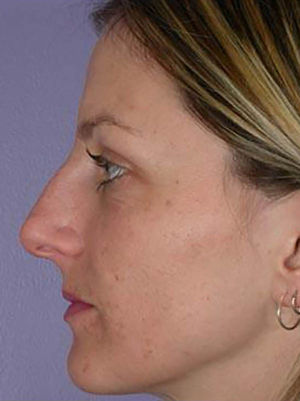 Rhinoplasty Before & After Image