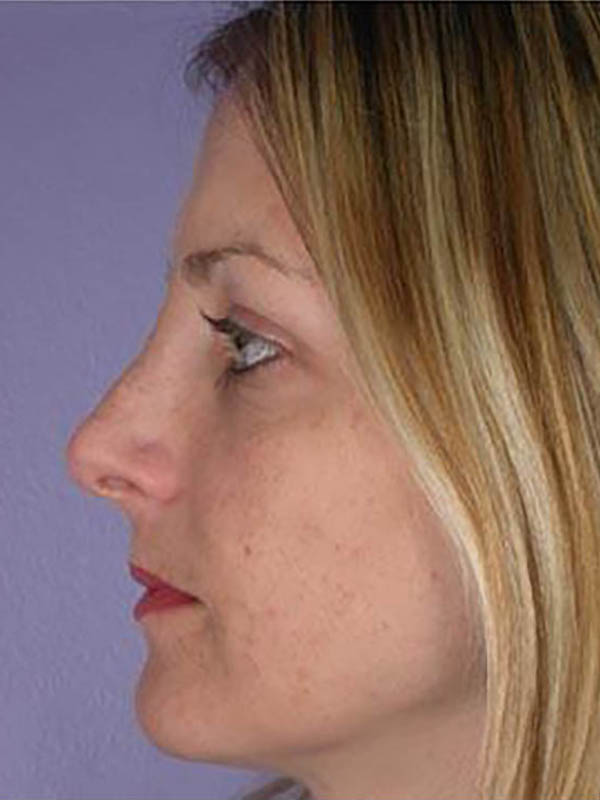 Rhinoplasty Before & After Image