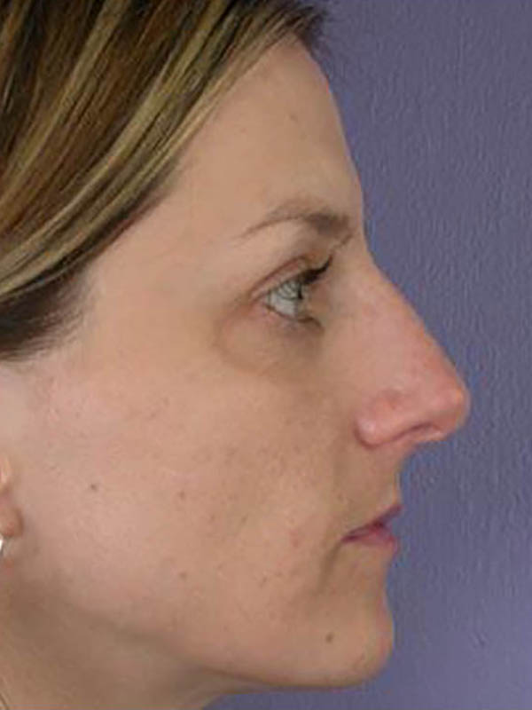 Rhinoplasty Before & After Image