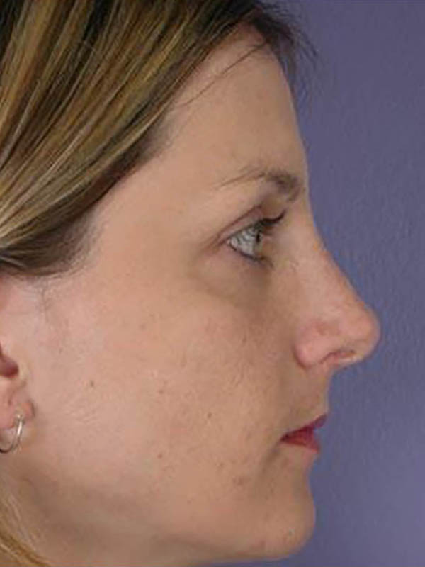 Rhinoplasty Before & After Image