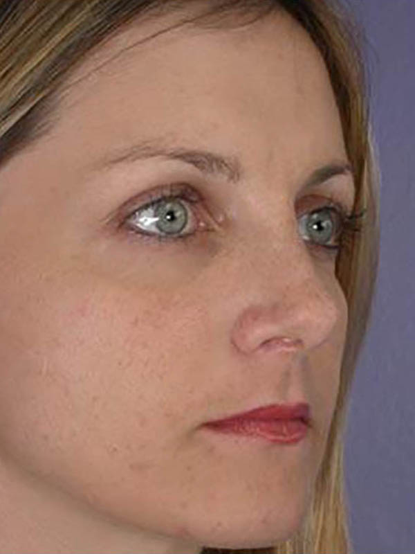 Rhinoplasty Before & After Image