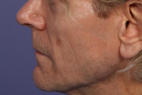 Sculptra Before & After Image