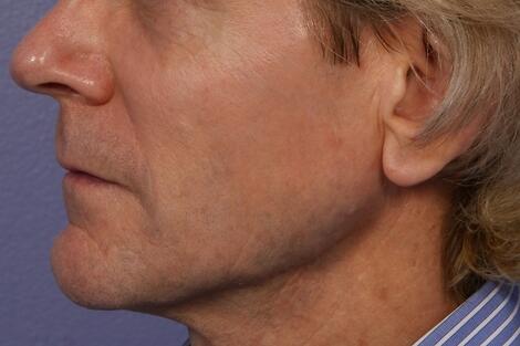 Sculptra Before & After Image