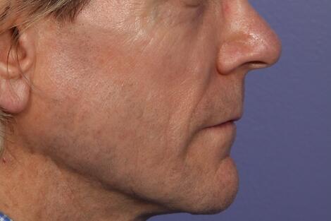 Sculptra Before & After Image