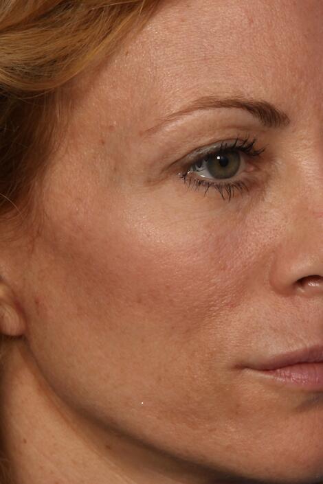 Sculptra Before & After Image