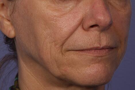 Sculptra Before & After Image