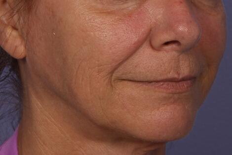 Sculptra Before & After Image