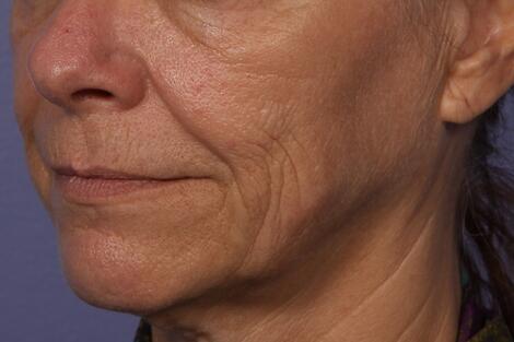 Sculptra Before & After Image