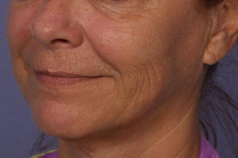 Sculptra Before & After Image