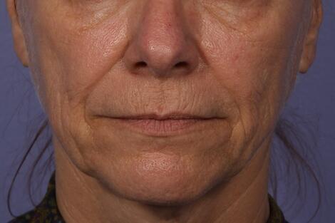 Sculptra Before & After Image