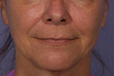 Sculptra Before & After Image