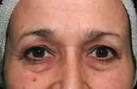 ThermaCool Non-Surgical Facelift Before & After Image