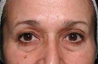 ThermaCool Non-Surgical Facelift Before & After Image