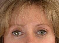 ThermaCool Non-Surgical Facelift Before & After Image