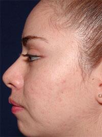 ThermaCool Non-Surgical Facelift Before & After Image