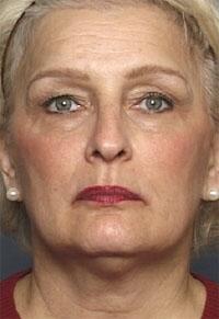 ThermaCool Non-Surgical Facelift Before & After Image