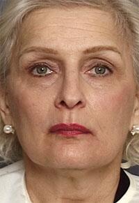 ThermaCool Non-Surgical Facelift Before & After Image