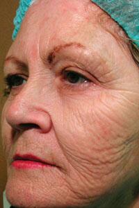 ThermaCool Non-Surgical Facelift Before & After Image