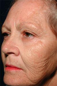 ThermaCool Non-Surgical Facelift Before & After Image