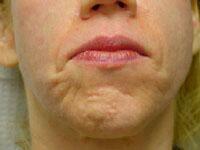 ThermaCool Non-Surgical Facelift Before & After Image