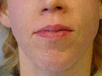 ThermaCool Non-Surgical Facelift Before & After Image