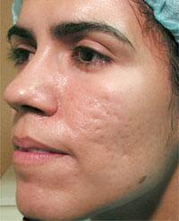 ThermaCool Non-Surgical Facelift Before & After Image