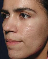 ThermaCool Non-Surgical Facelift Before & After Image