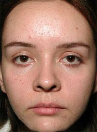 ThermaCool Non-Surgical Facelift Before & After Image