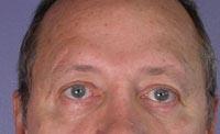 ThermaCool Non-Surgical Facelift Before & After Image