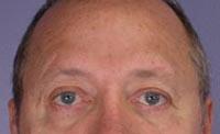 ThermaCool Non-Surgical Facelift Before & After Image