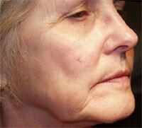 ThermaCool Non-Surgical Facelift Before & After Image