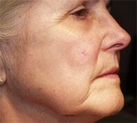 ThermaCool Non-Surgical Facelift Before & After Image