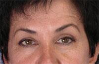 ThermaCool Non-Surgical Facelift Before & After Image