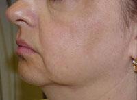 ThermaCool Non-Surgical Facelift Before & After Image